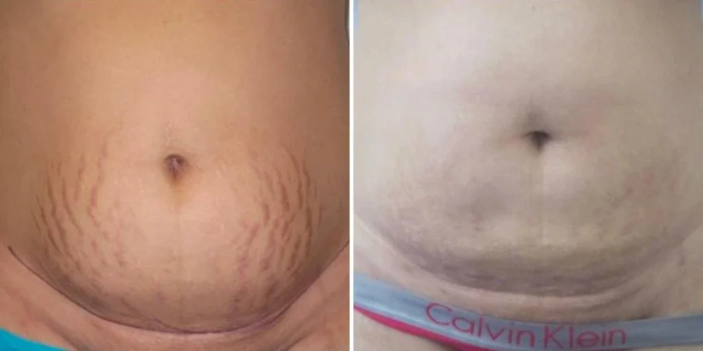 stretch marks female pre2024 004 before and after before and after