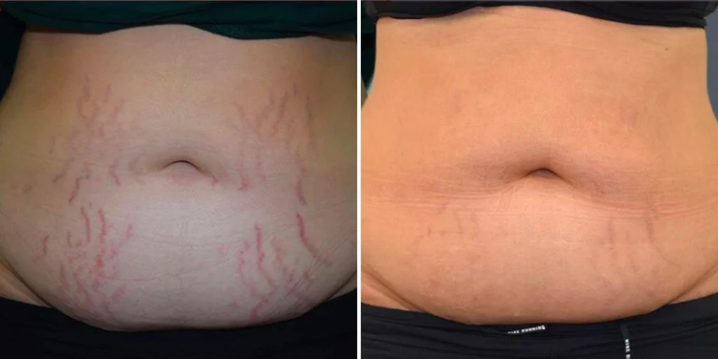stretch marks female pre2024 007 before and after before and after