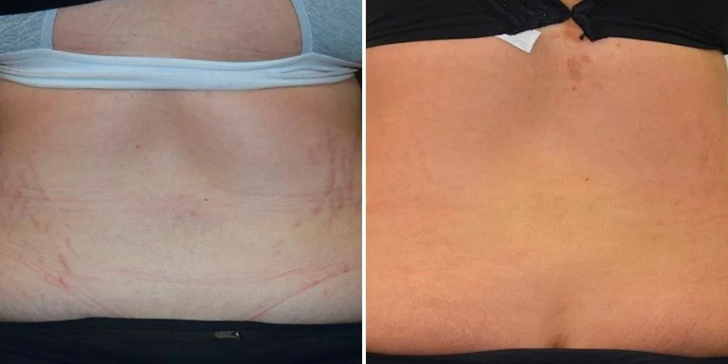 stretch marks female pre2024 008 before and after before and after