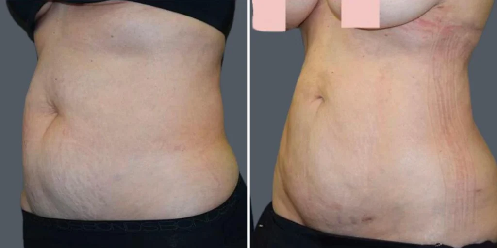 stretch marks female pre2024 010 before and after before and after