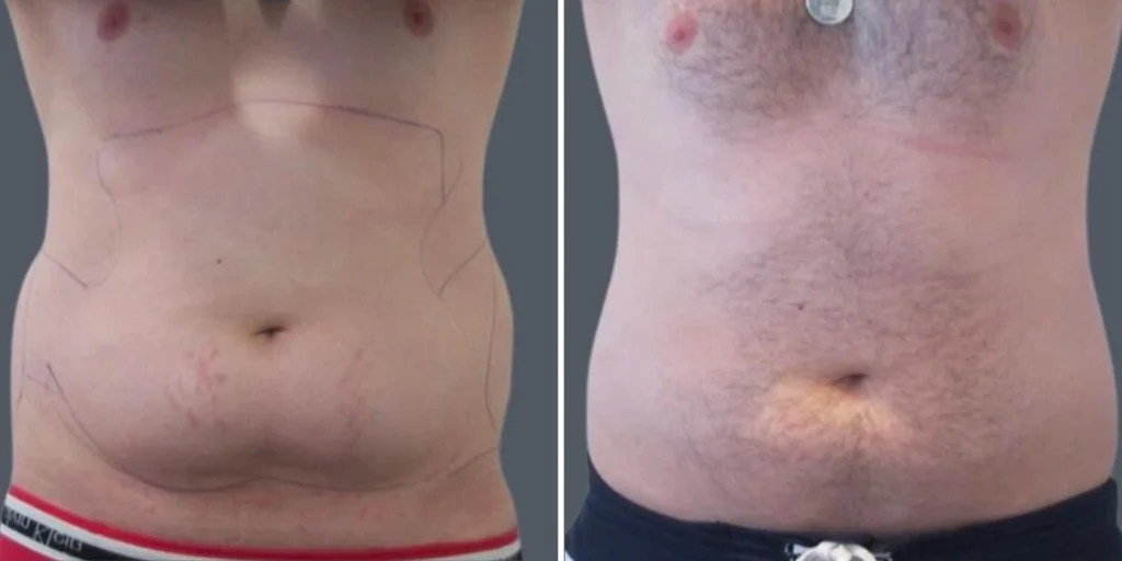 stretch marks male pre2024 002 before and after before and after