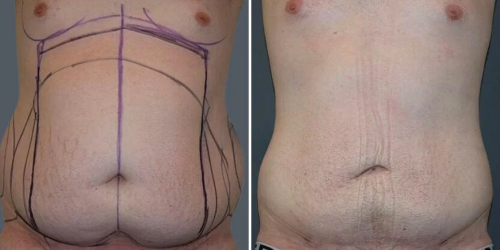 stretch marks male pre2024 006 before and after before and after