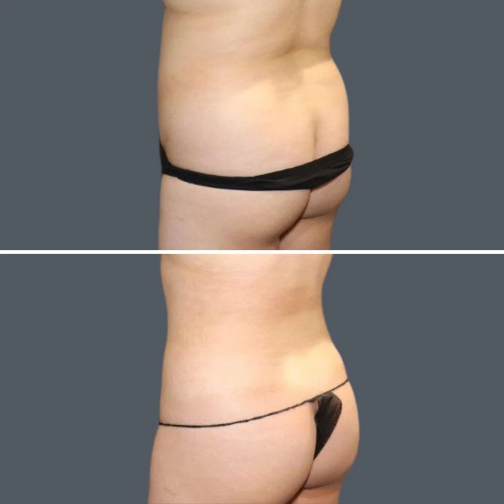 sydney back liposuction female 2024 sg 005 before and after before and after