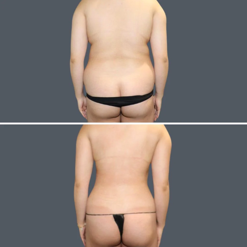 sydney back liposuction female 2024 sg 007 before and after before and after