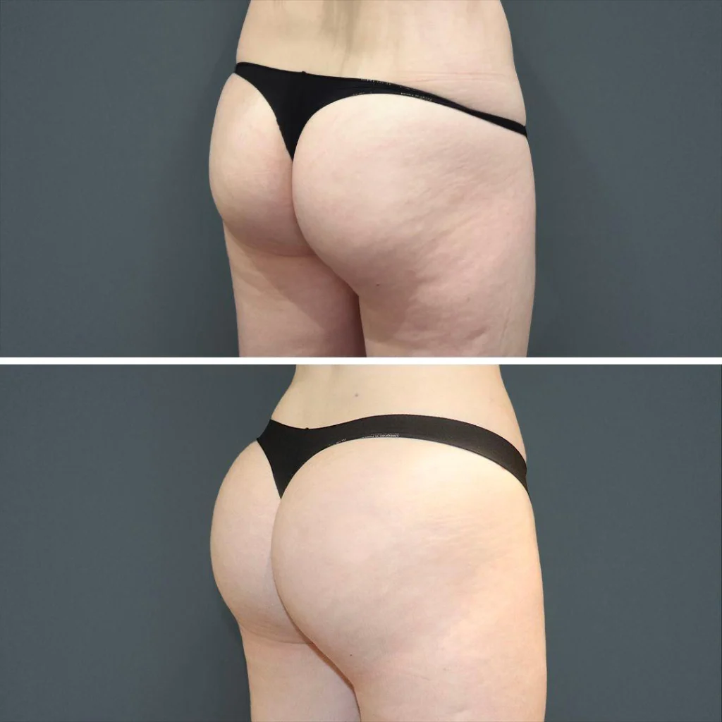 sydney bbl butt female 2023 right tc before and after before and after
