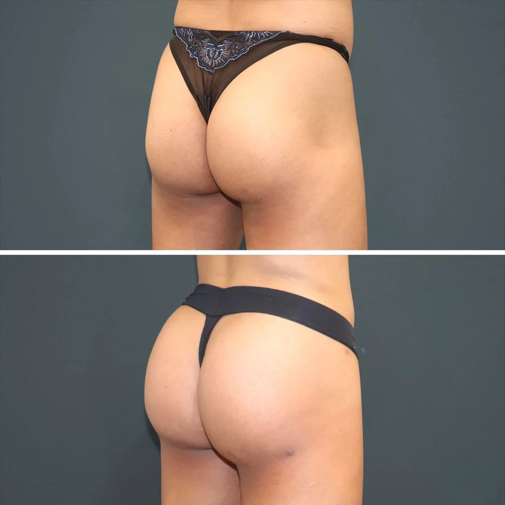 sydney bbl butt male 2021 left jg before and after before and after