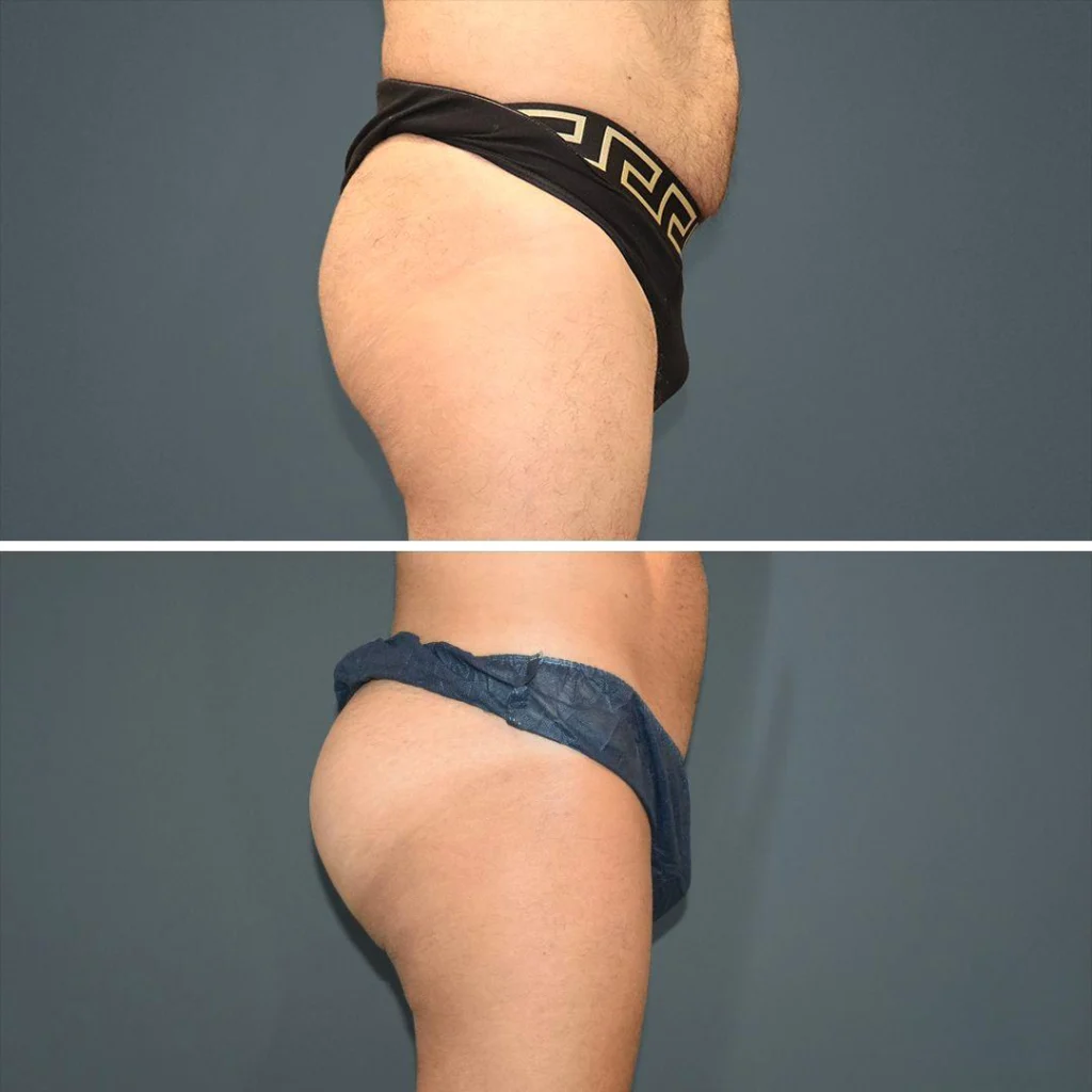 sydney bbl butt male 2021 left lj before and after before and after