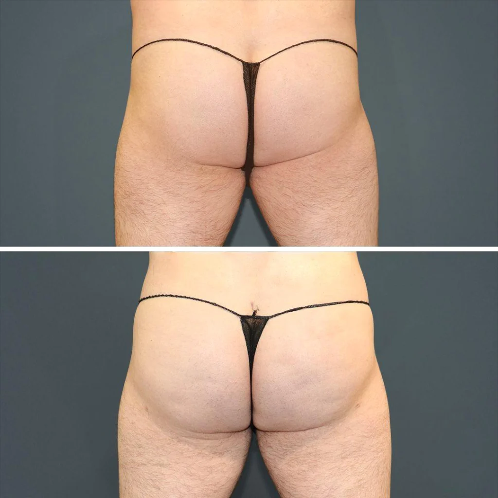 sydney bbl butt male 2021 rear jh before and after before and after