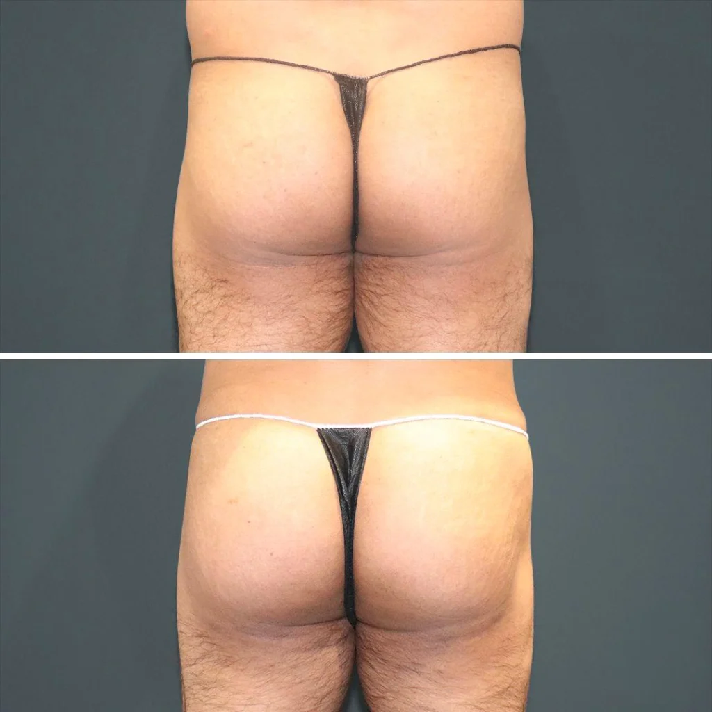 sydney bbl butt male 2021 rear jl before and after before and after