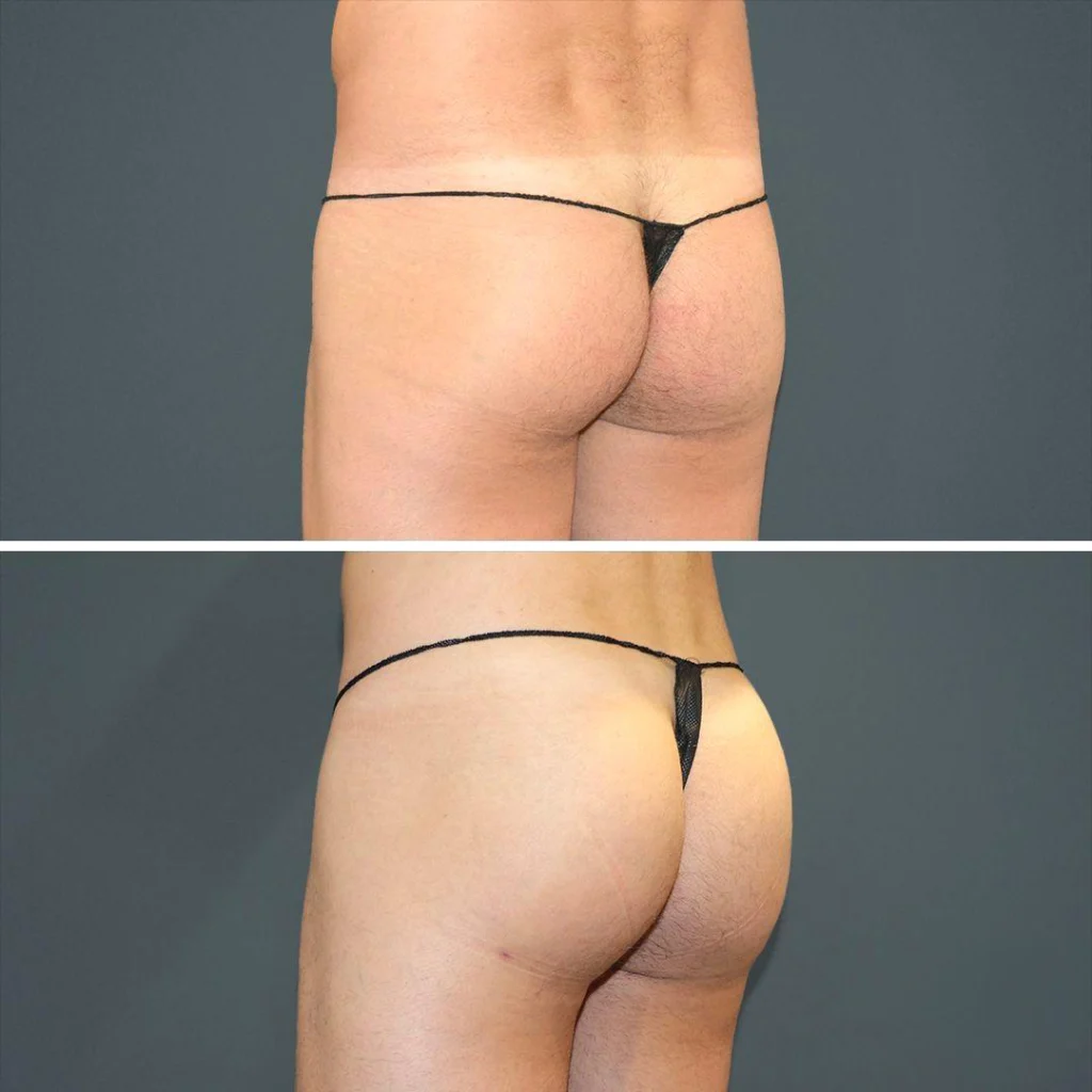 sydney bbl butt male 2021 right jt before and after before and after