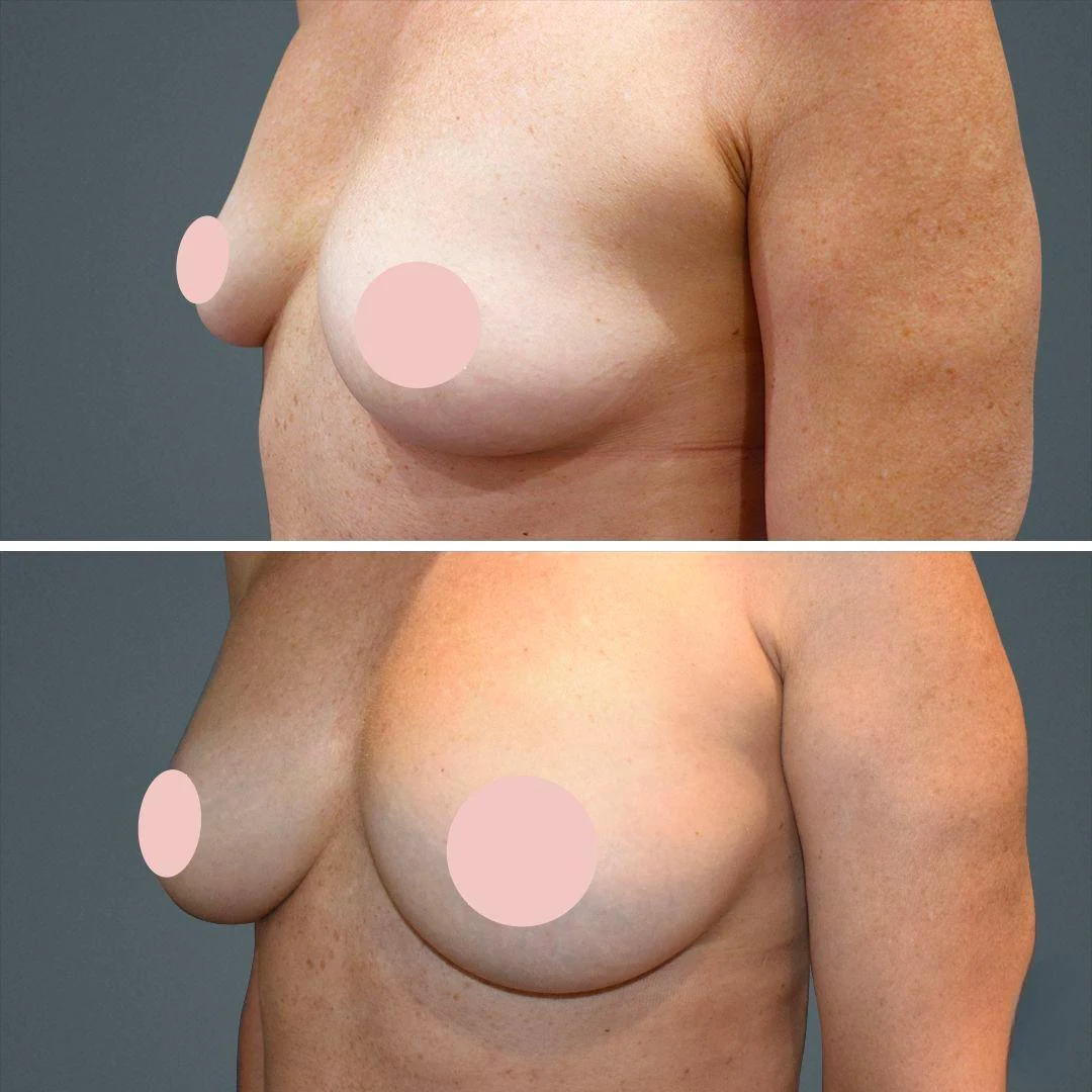 Breast Fat Transfer Before & After before and after at Cosmos Clinic