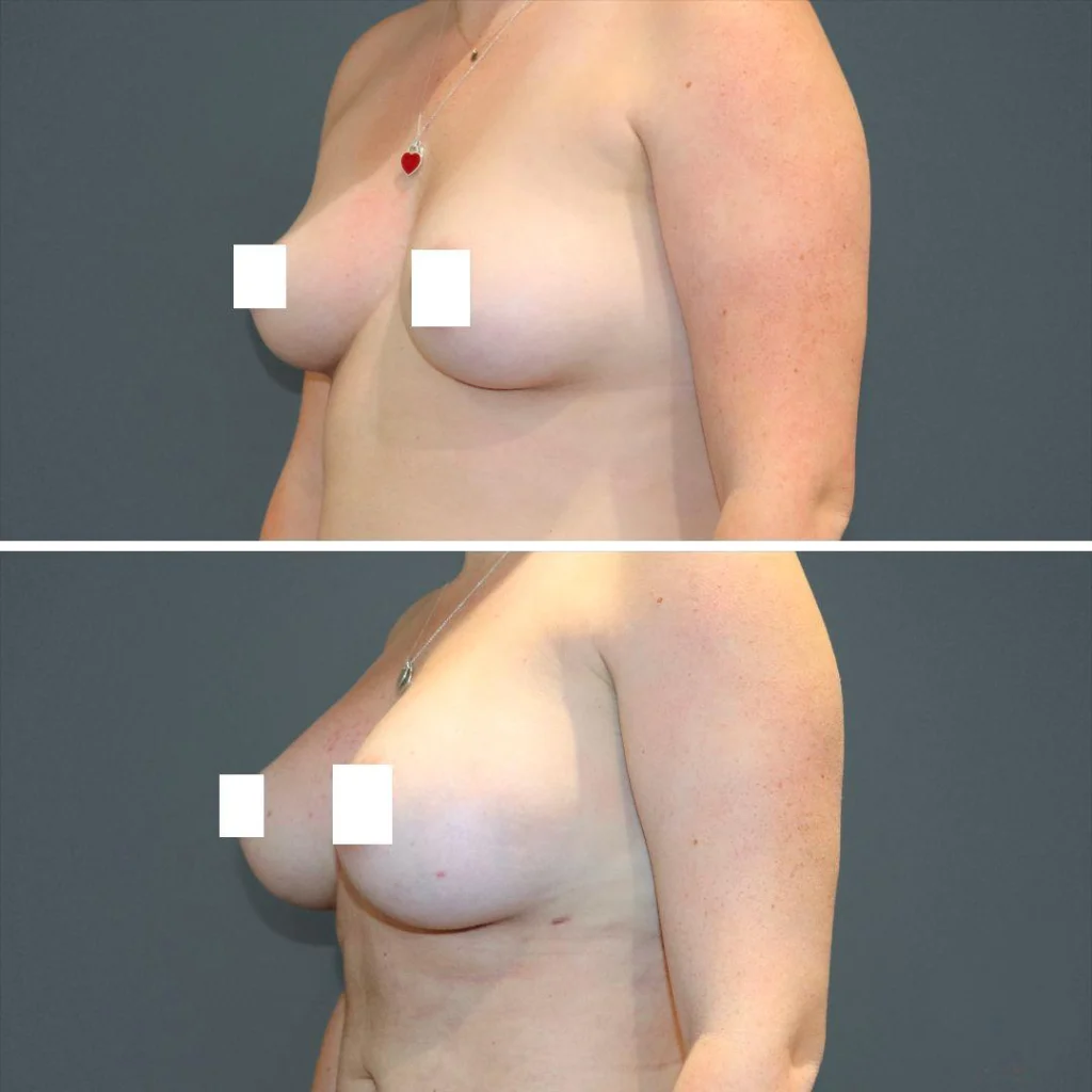 sydney liposuction breast female 2021 right tb before and after before and after