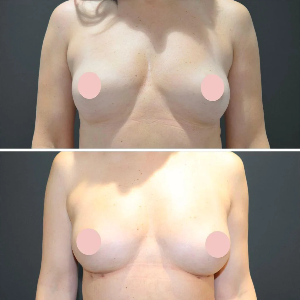 sydney liposuction breast female 2022 front nc before and after before and after