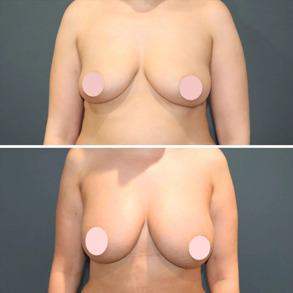 sydney liposuction breast female 2022 front zs before and after before and after