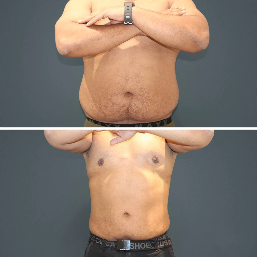 sydney liposuction stomach male 2022 front ym before and after before and after
