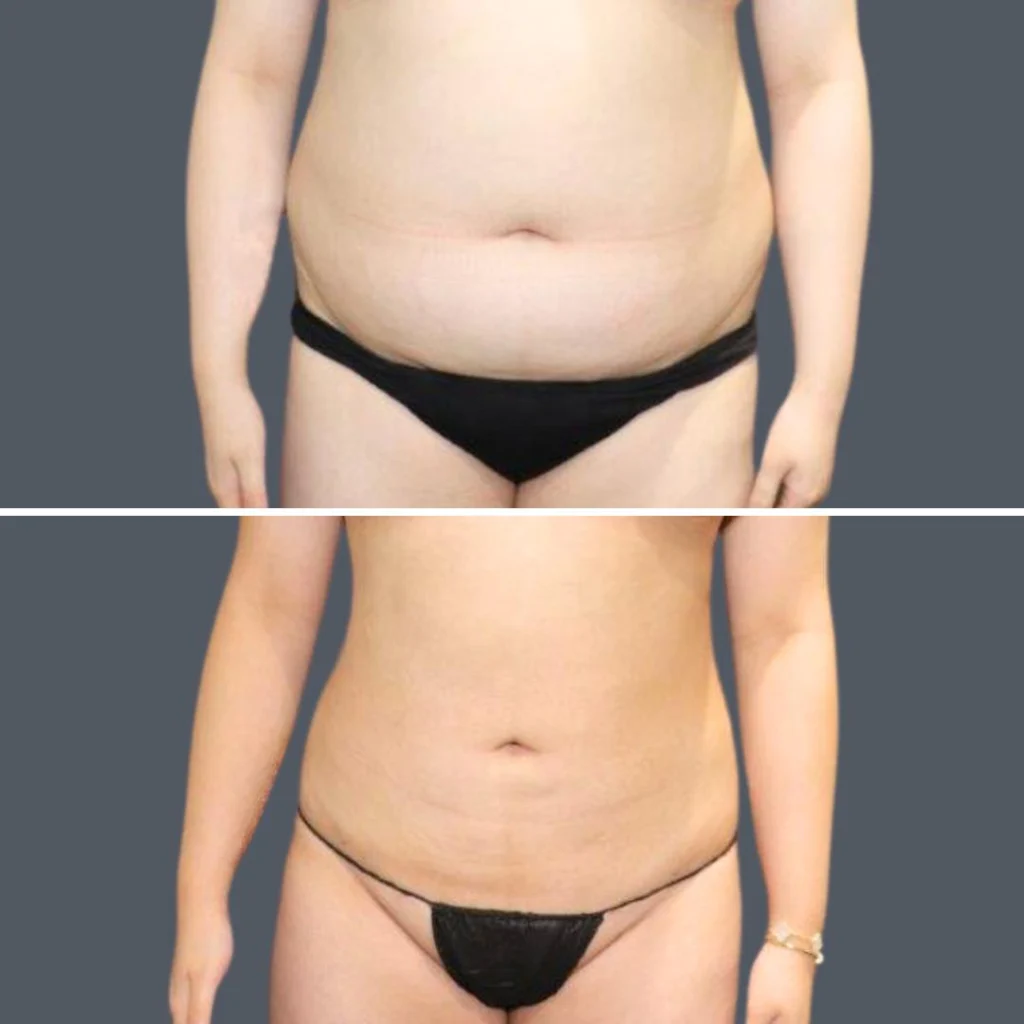 Vaser Liposuction before and after at Cosmos Clinic