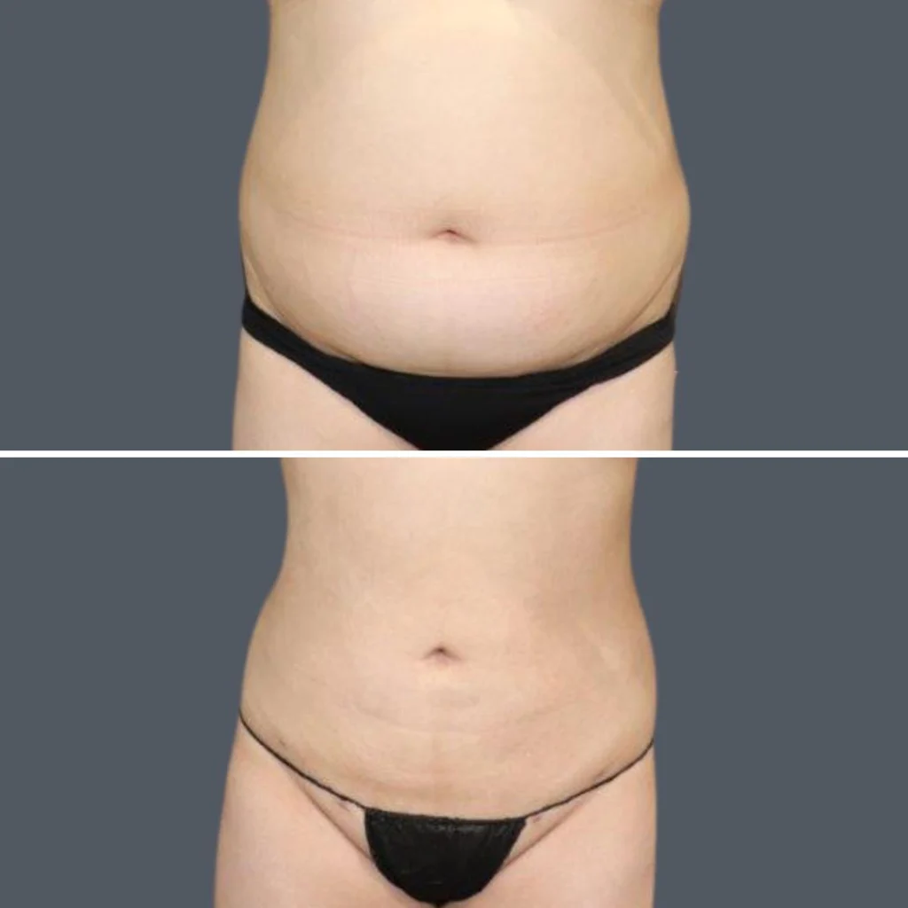 sydney stomach liposuction female 2024 sg 002 before and after before and after