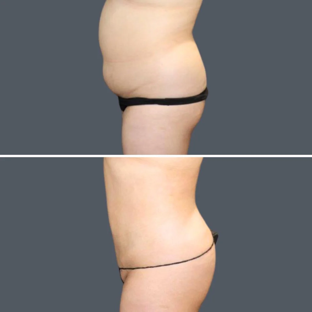 sydney stomach liposuction female 2024 sg 004 before and after before and after