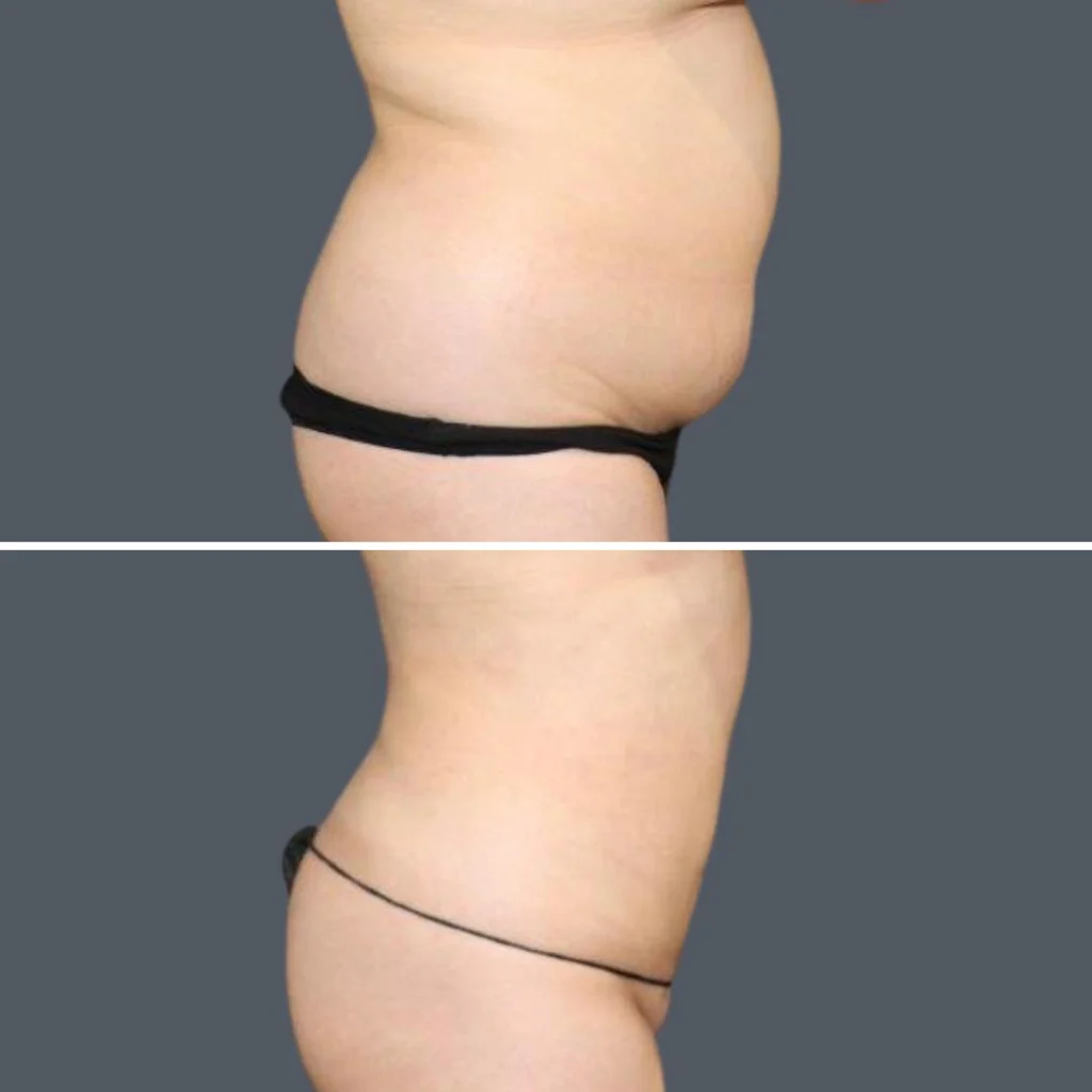sydney stomach liposuction female 2024 sg 009 before and after before and after
