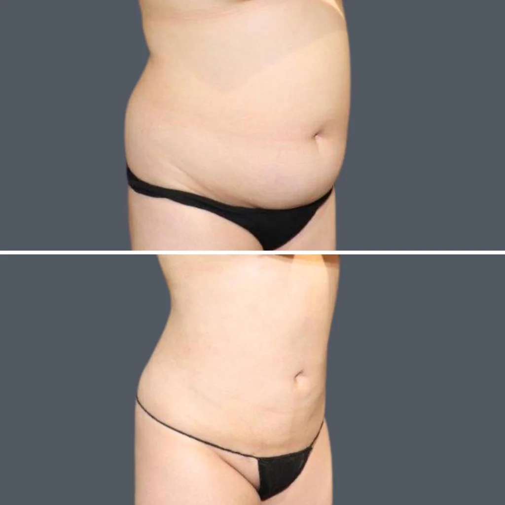 sydney stomach liposuction female 2024 sg 010 before and after before and after