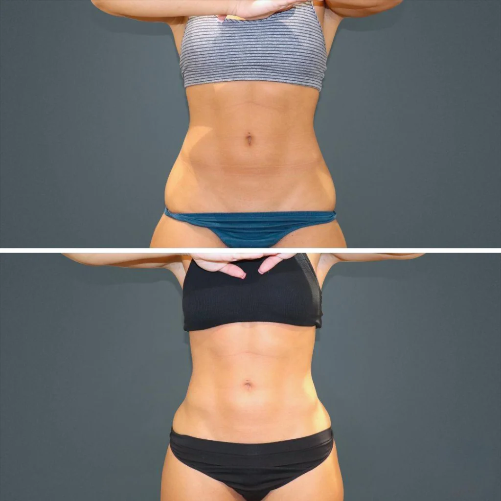 sydney vaserhidefliposuction stomach female 2022 front rc before and after before and after