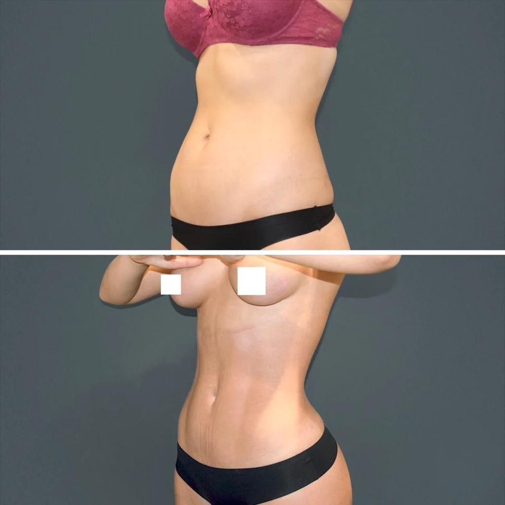 sydney vaserhidefliposuction stomach female 2022 right rl before and after before and after