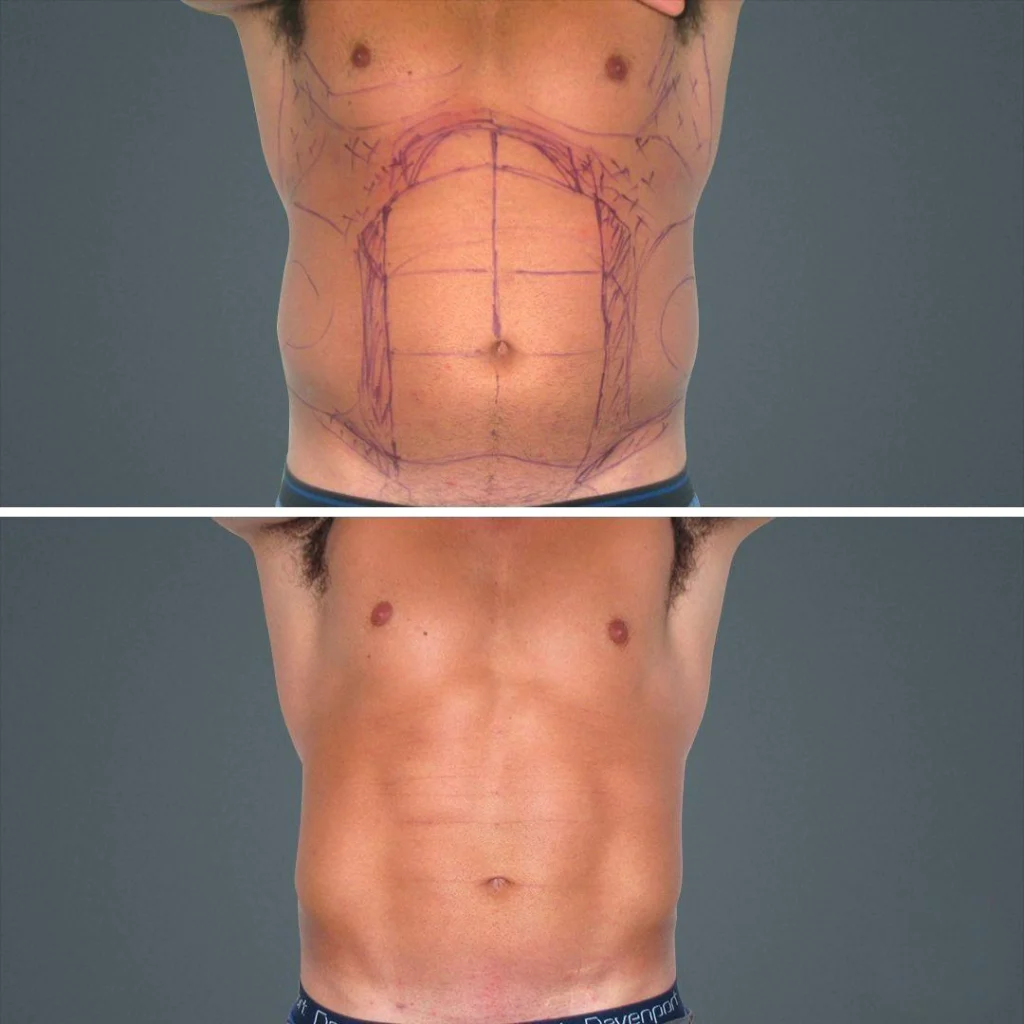 sydney vaserhidefliposuction stomach male 2021 front rn before and after before and after