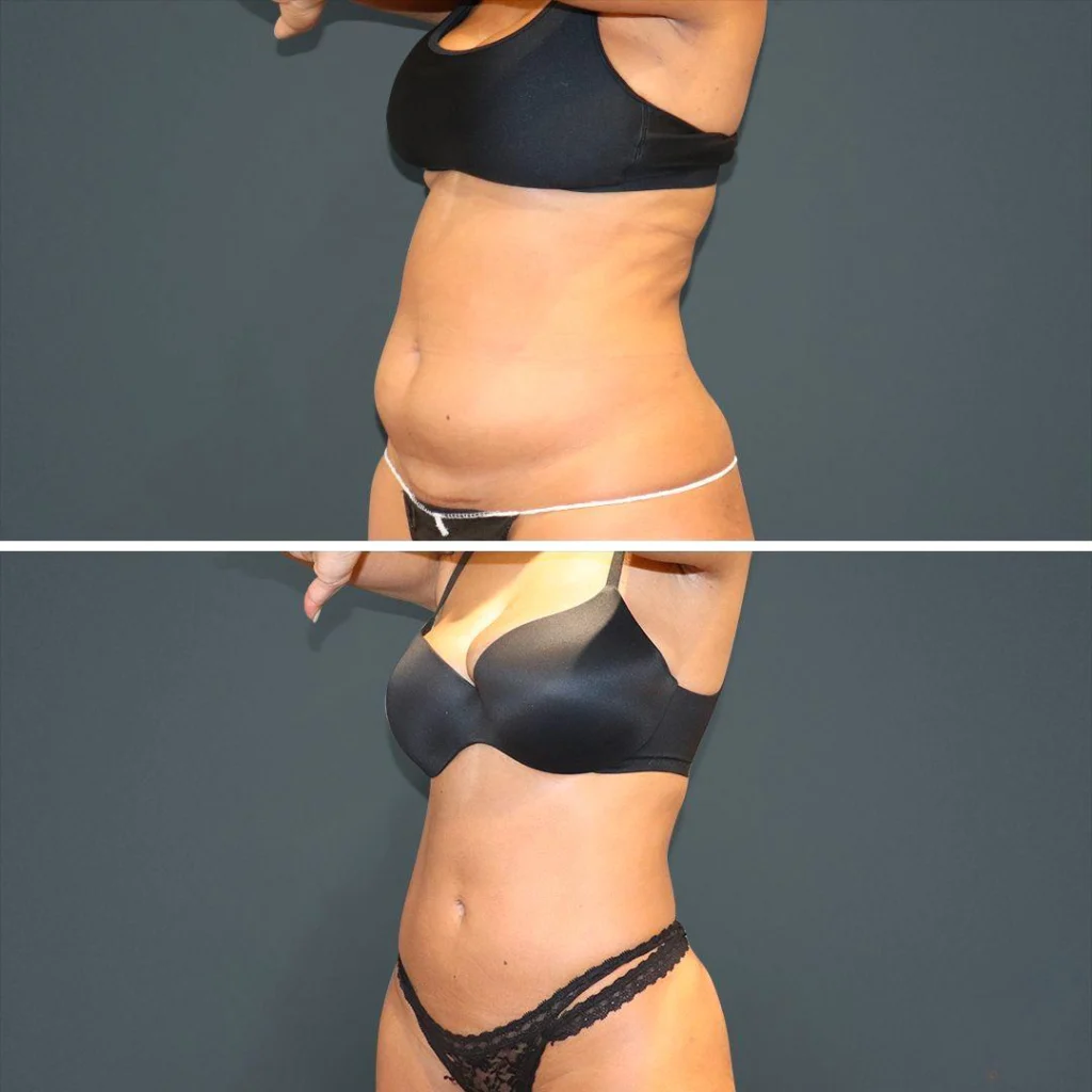 sydney vaserliposuction stomach female 2022 right mc before and after before and after