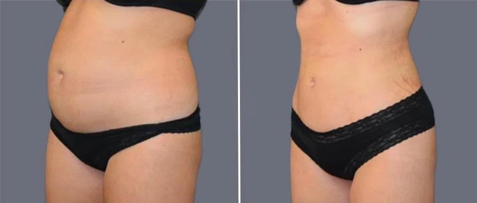 tummy vaser female pre2024 001 before and after before and after