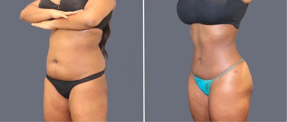 tummy vaser female pre2024 002 before and after before and after