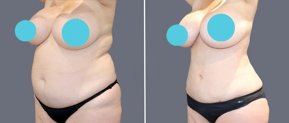 tummy vaser female pre2024 004 before and after before and after