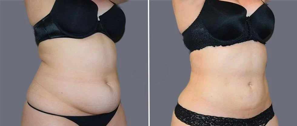 tummy vaser female pre2024 005 before and after before and after