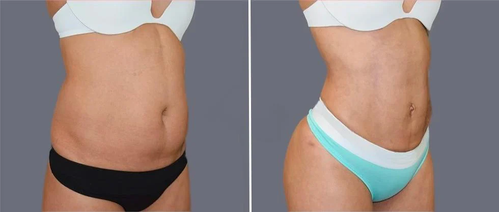 tummy vaser female pre2024 007 before and after before and after