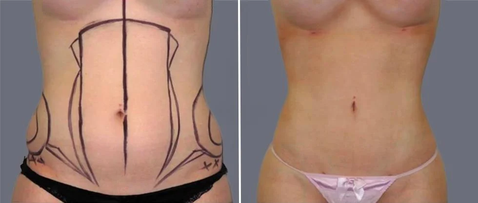 tummy vaser female pre2024 009 before and after before and after