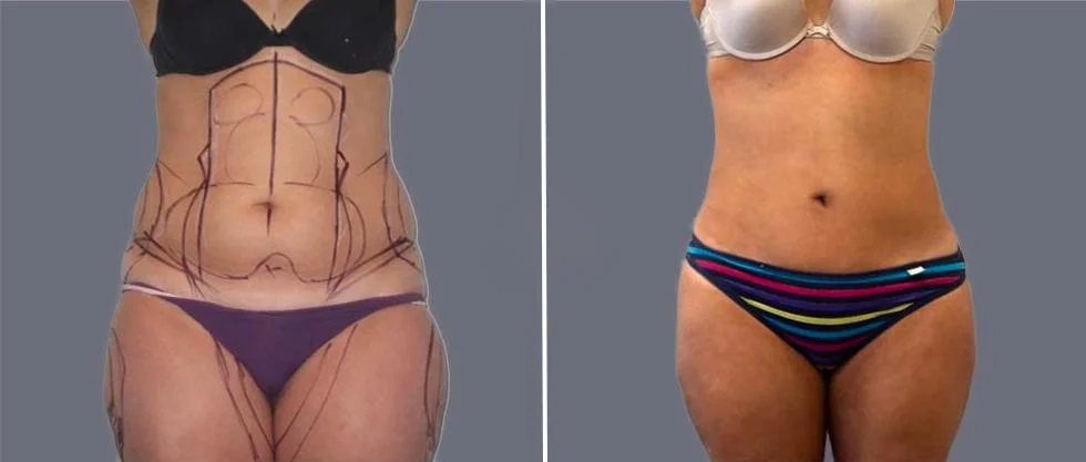 tummy vaser female pre2024 010 before and after before and after