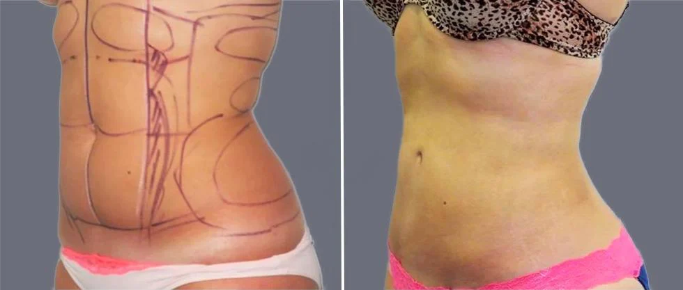tummy vaser female pre2024 011 before and after before and after