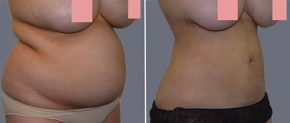 tummy vaser female pre2024 017 before and after before and after