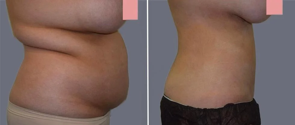 tummy vaser female pre2024 018 before and after before and after