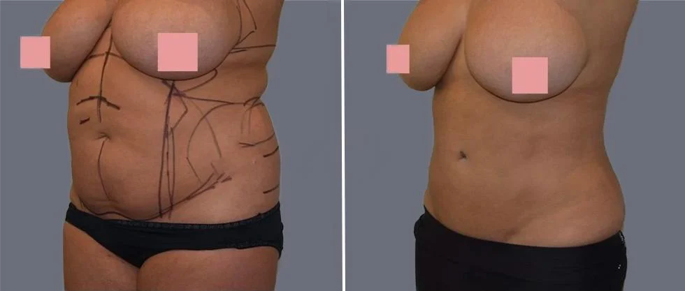 tummy vaser female pre2024 019 before and after before and after