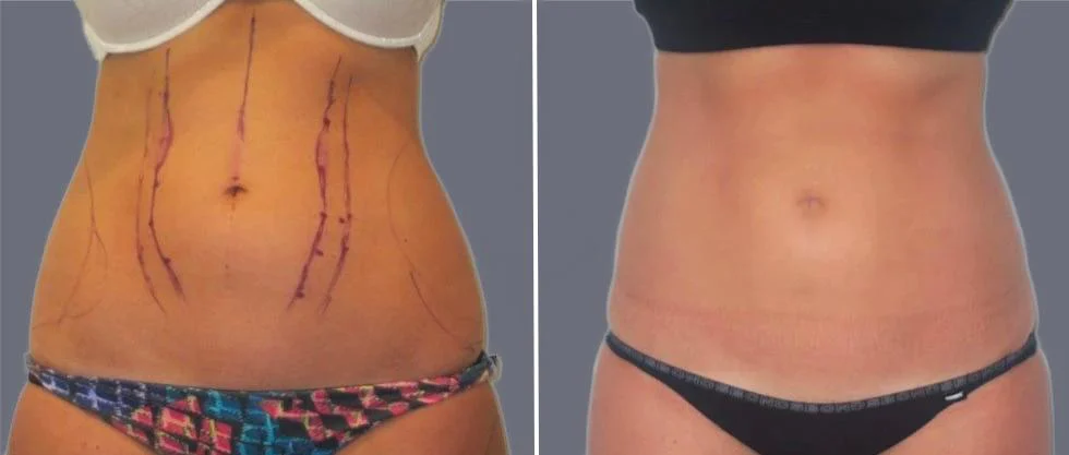 tummy vaser female pre2024 020 before and after before and after