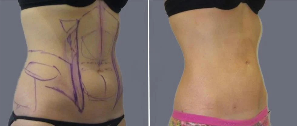 tummy vaser female pre2024 023 before and after before and after
