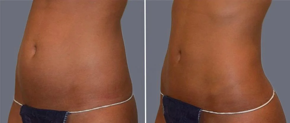 tummy vaser female pre2024 024 before and after before and after