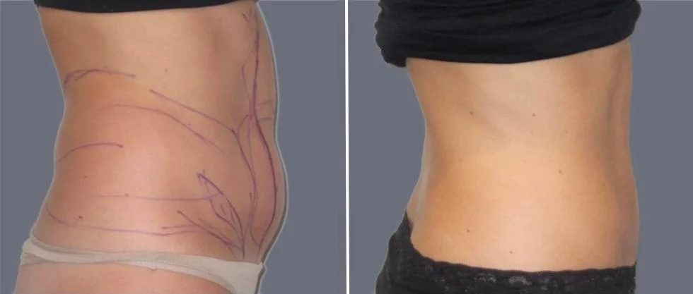 tummy vaser female pre2024 026 before and after before and after
