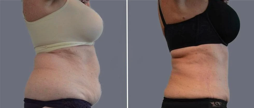 tummy vaser female pre2024 027 before and after before and after