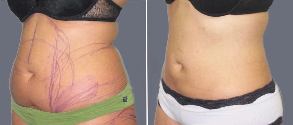 tummy vaser female pre2024 028 before and after before and after