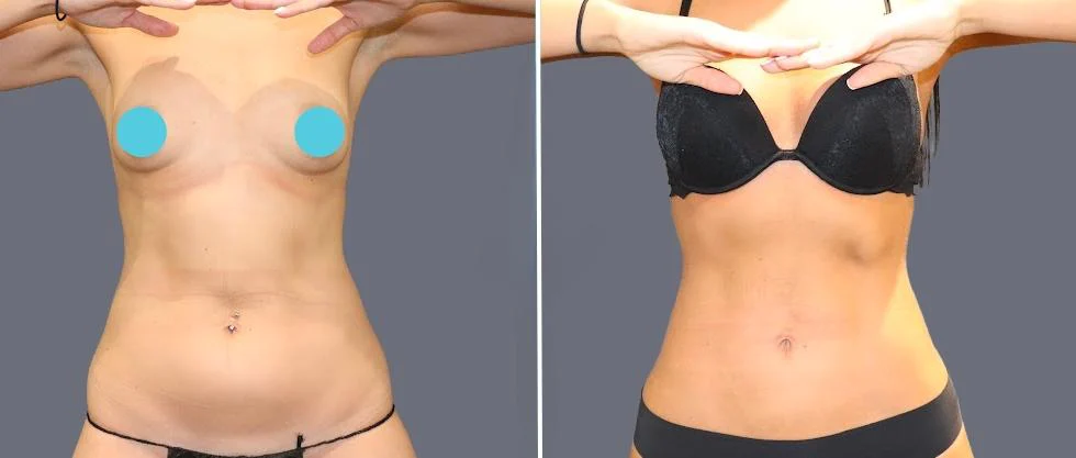 tummy vaser female pre2024 030 before and after before and after