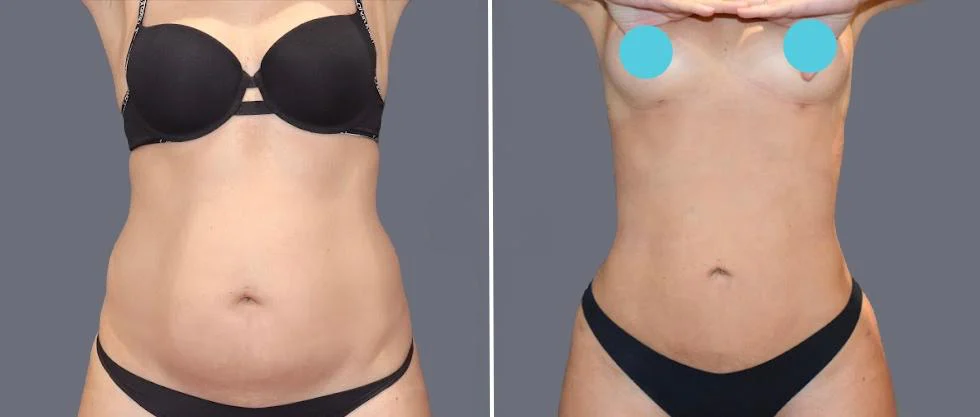 tummy vaser female pre2024 031 before and after before and after