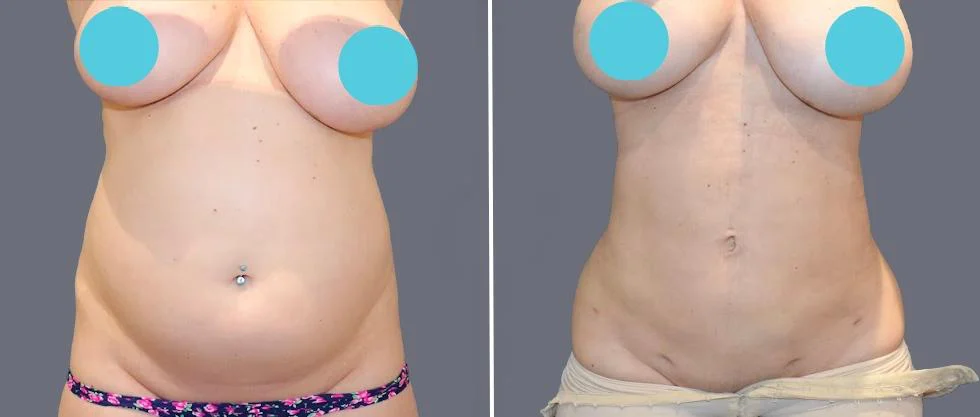 tummy vaser female pre2024 035 before and after before and after