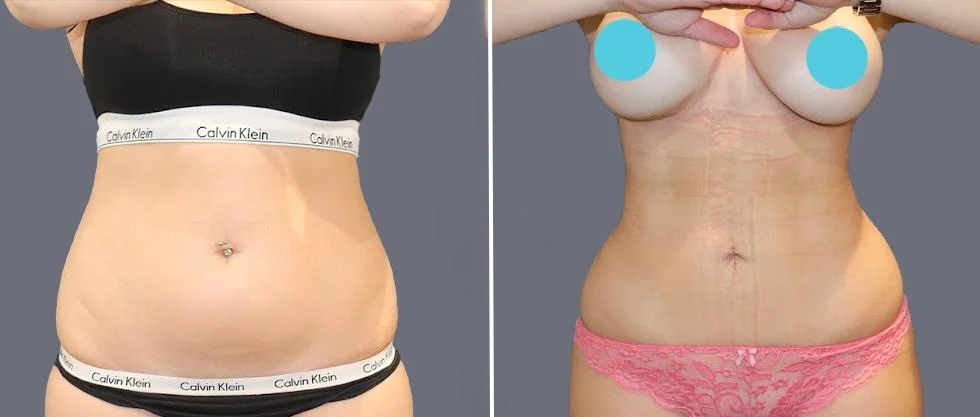 tummy vaser female pre2024 036 before and after before and after