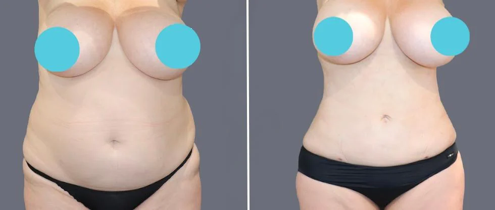 tummy vaser female pre2024 037 before and after before and after